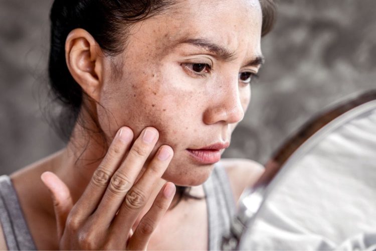 ¿Qué significan las manchas marrones en la piel?
