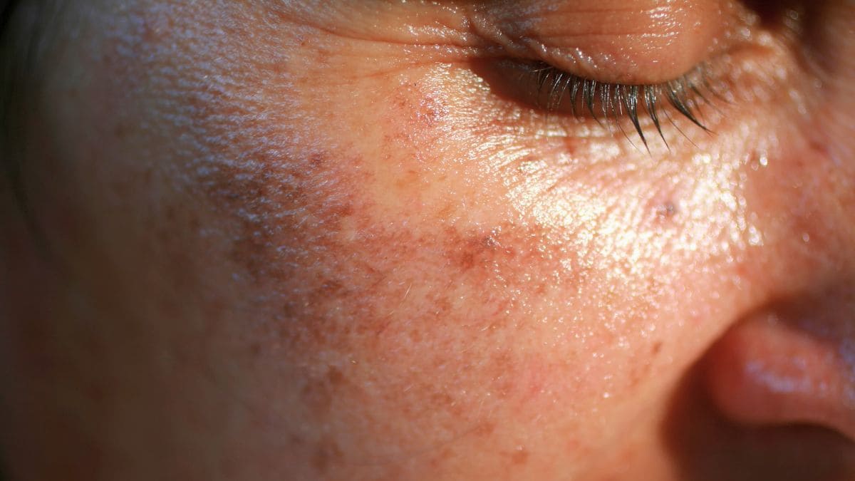 Dermatólogos explican cómo preparar piel verano